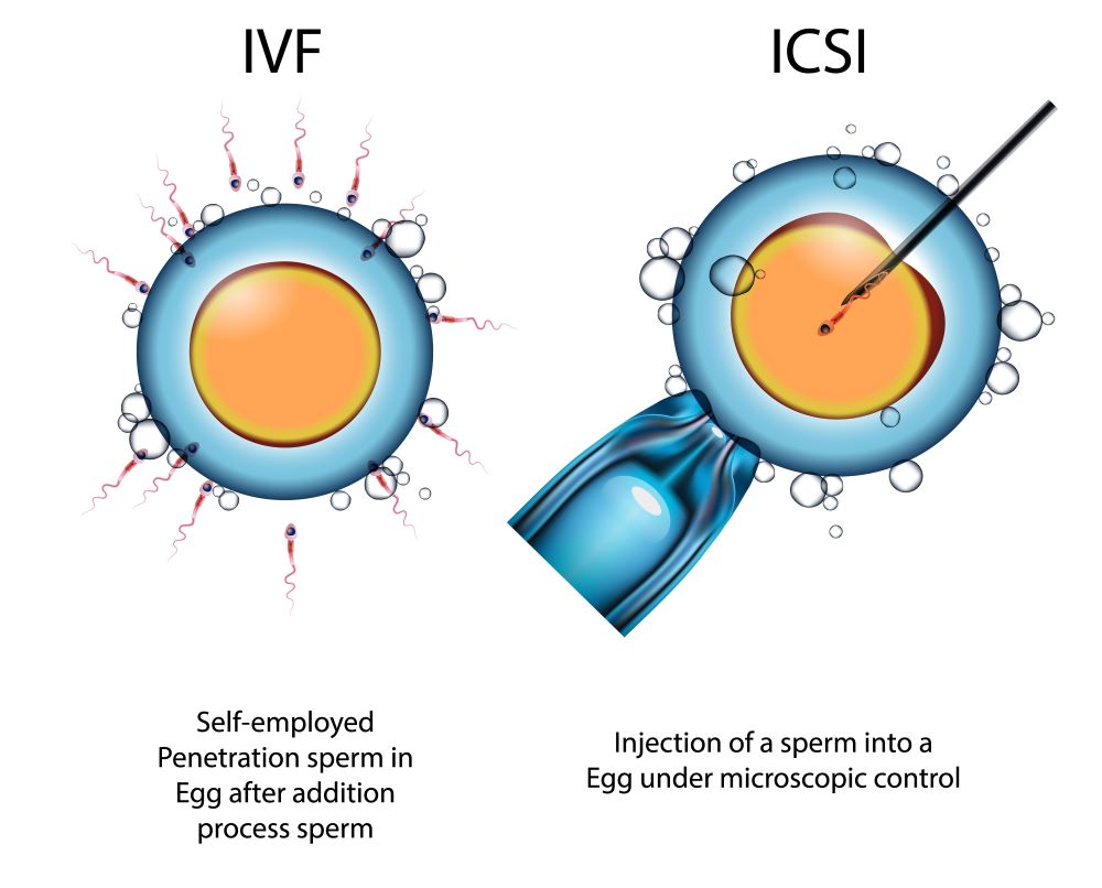 การทำ ICSI 