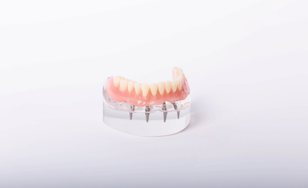 All-on-4 dental implants must be kept clean. 