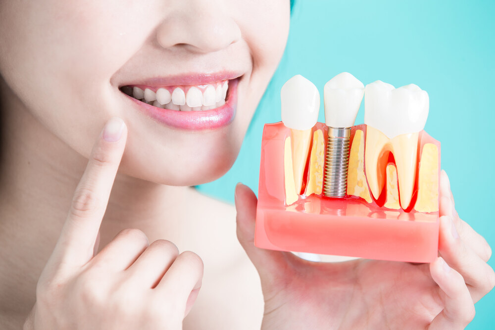 A woman holding a dental implant sample