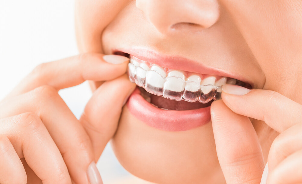 Most people are perfect candidates for Invisalign. 