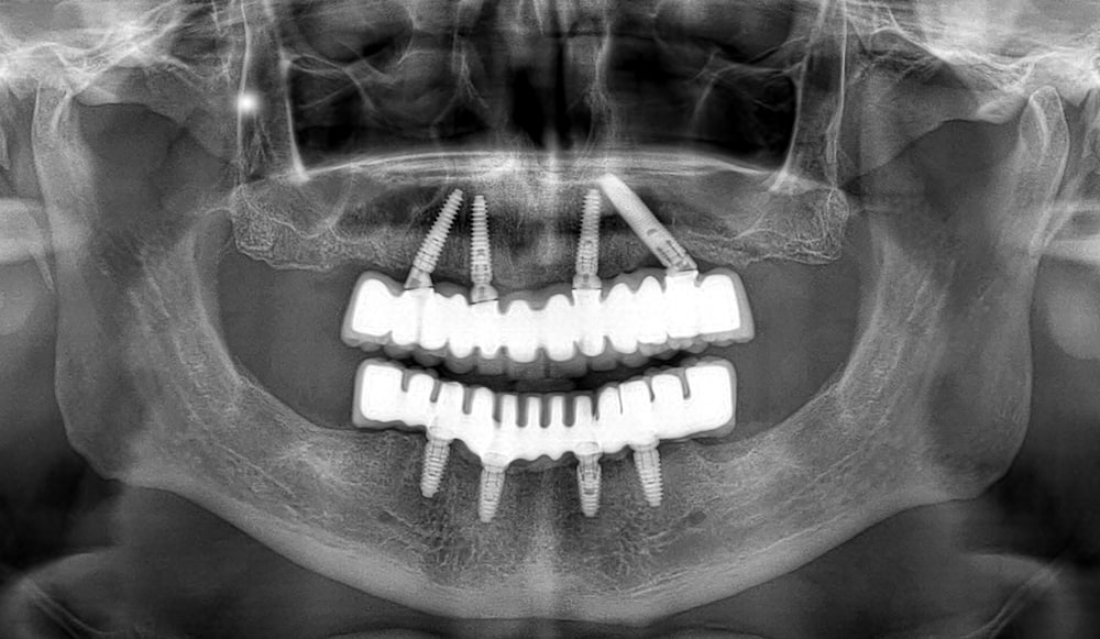 An X-ray image of a patient with all-on-4 dental implants