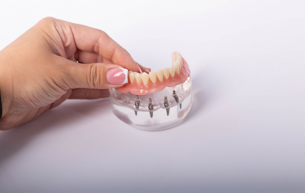 A woman holding all-on-4 dental implants